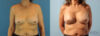 Breast Augmentation case #6297 slider thumbnail