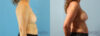 Breast Augmentation case #6297 slider thumbnail