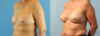 Breast Augmentation case #6297 slider thumbnail