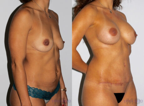 Mommy Makeover case #6504