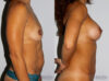 Mommy Makeover case #6504 slider thumbnail