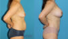 Mommy Makeover case #6512 slider thumbnail