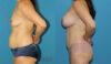 Mommy Makeover case #6512 slider thumbnail