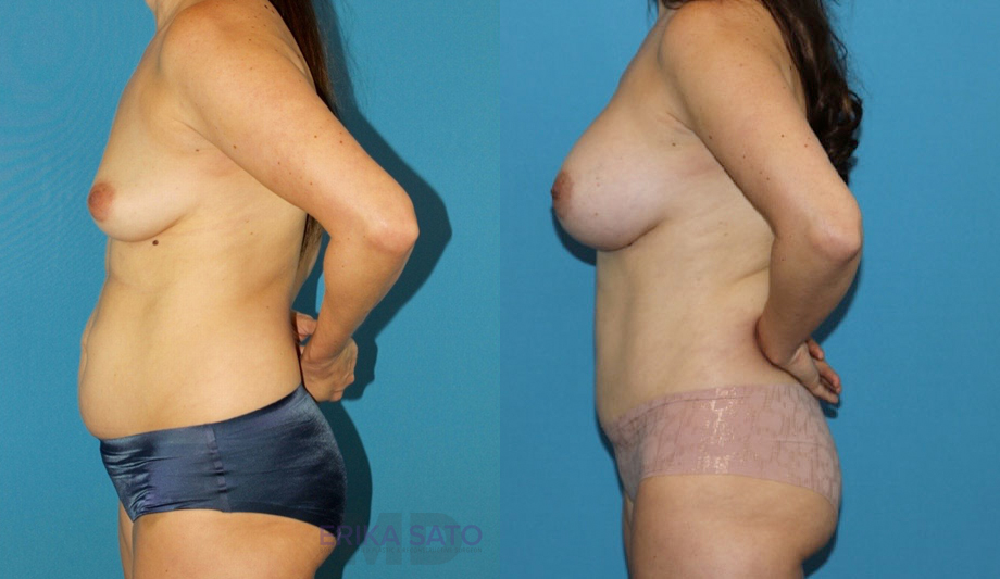 Mommy Makeover case #6512
