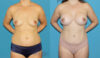 Mommy Makeover case #6512 slider thumbnail