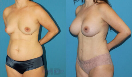 Mommy Makeover case #6512