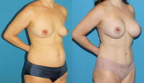 Mommy Makeover case #6512