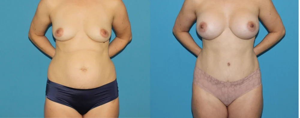 Mommy Makeover case #6512