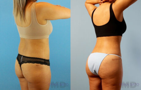 Brazilian Butt Lift case #4881