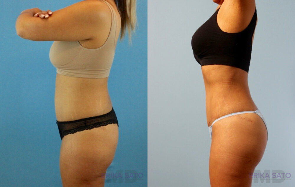 Brazilian Butt Lift case #4881