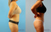 Brazilian Butt Lift case #4881 slider thumbnail
