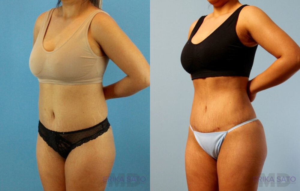 Brazilian Butt Lift case #4881