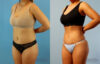 Brazilian Butt Lift case #4881 slider thumbnail