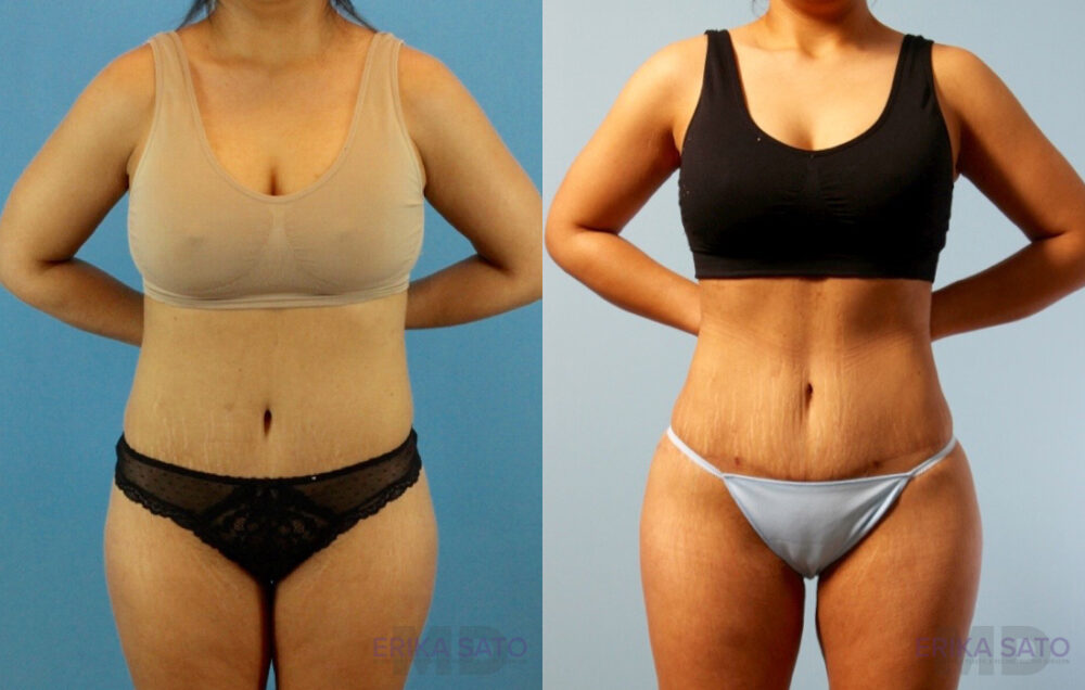 Brazilian Butt Lift case #4881