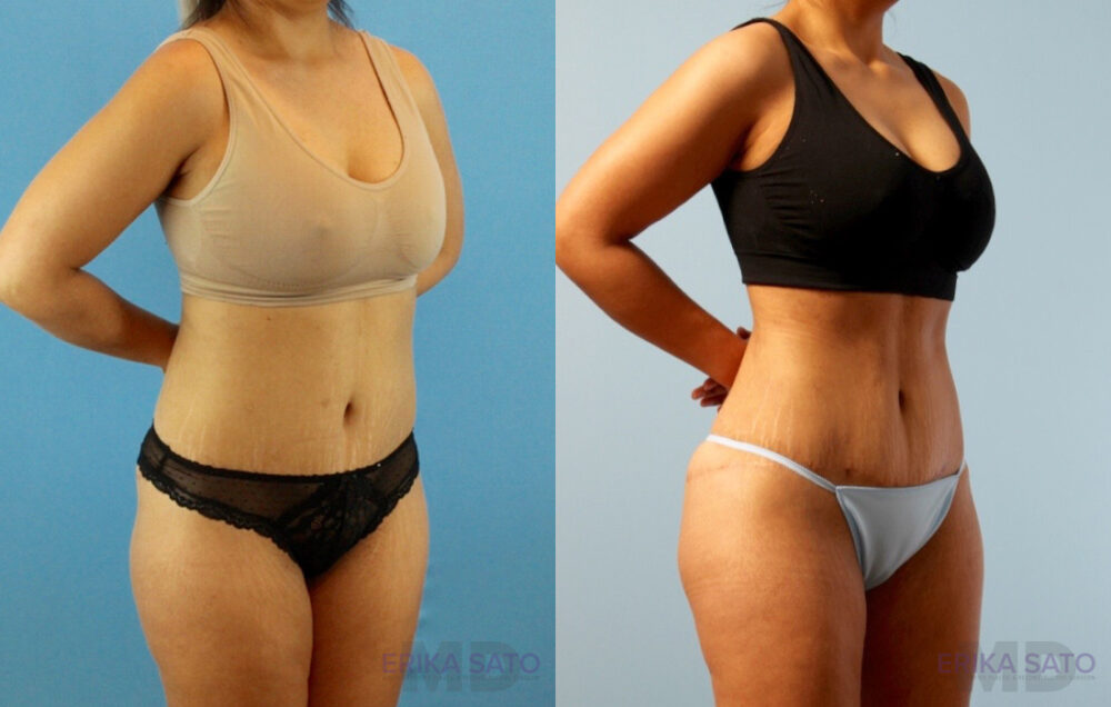 Brazilian Butt Lift case #4881
