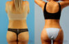 Brazilian Butt Lift case #4881 slider thumbnail