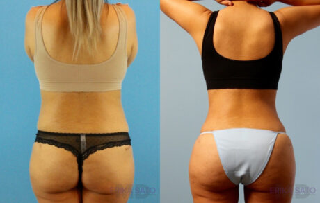 Brazilian Butt Lift case #4881