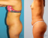 Brazilian Butt Lift case #4823 slider thumbnail
