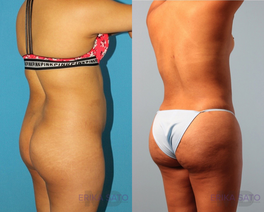 Brazilian Butt Lift case #4823