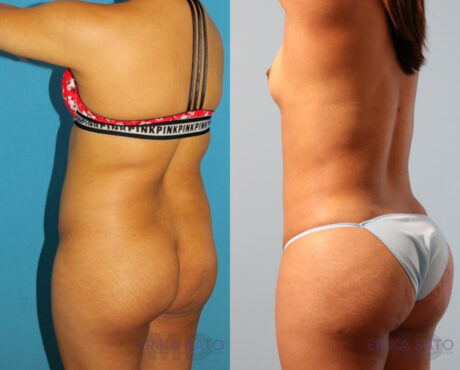 Brazilian Butt Lift case #4823