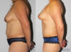 Mommy Makeover case #6503 slider thumbnail