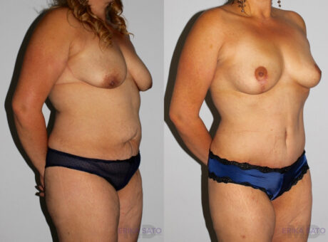 Mommy Makeover case #6503