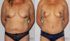 Mommy Makeover case #6503 slider thumbnail