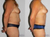 Mommy Makeover case #6503 slider thumbnail