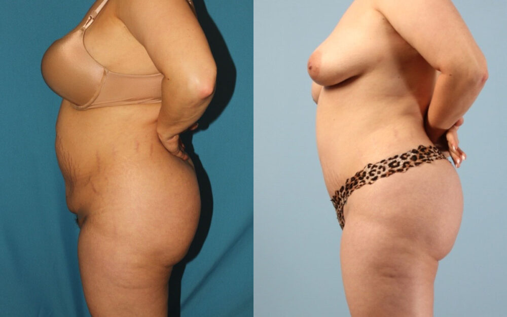 Tummy Tuck case #7342