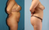 Tummy Tuck case #7342 slider thumbnail