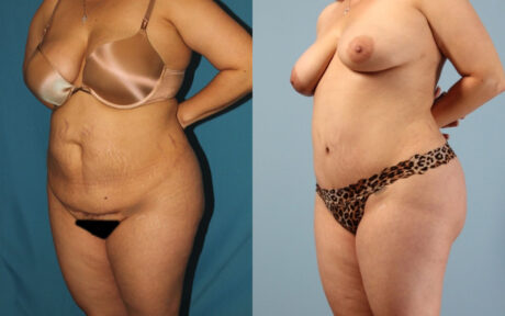 Tummy Tuck case #7342