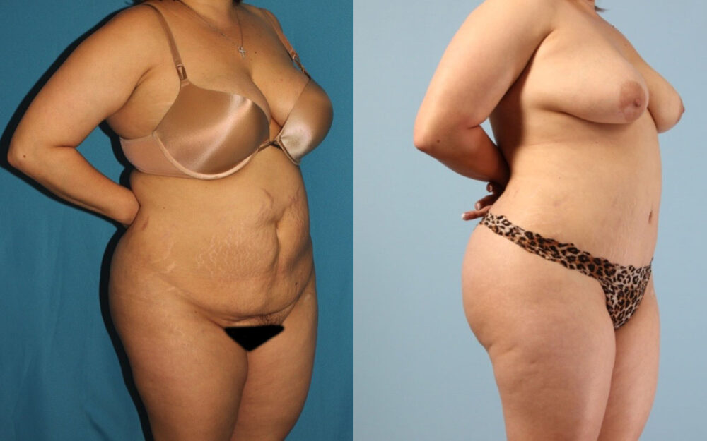 Tummy Tuck case #7342