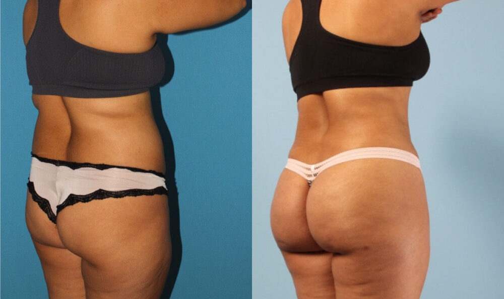Brazilian Butt Lift case #4902