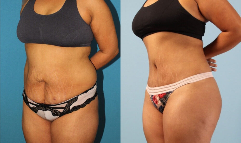 Brazilian Butt Lift case #4902