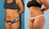 Brazilian Butt Lift case #4902 slider thumbnail