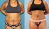 Brazilian Butt Lift case #4902 slider thumbnail