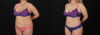 Tummy Tuck case #7775 slider thumbnail