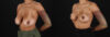 Breast Reduction case #8025 slider thumbnail