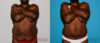 Post Bariatric Surgery (Massive Weight Loss) case #6774 slider thumbnail