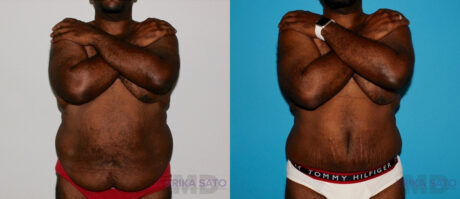 Post Bariatric Surgery (Massive Weight Loss) case #6774