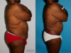 Post Bariatric Surgery (Massive Weight Loss) case #6774 slider thumbnail