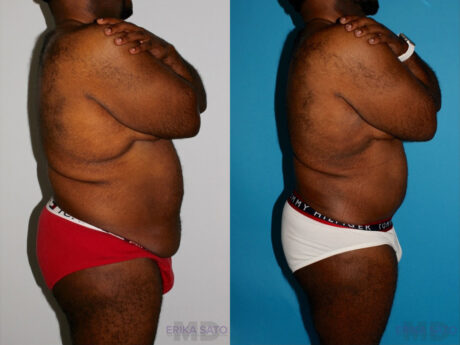 Post Bariatric Surgery (Massive Weight Loss) case #6774