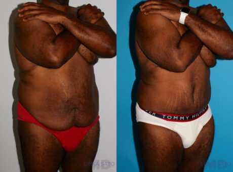 Post Bariatric Surgery (Massive Weight Loss) case #6774