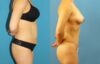 Tummy Tuck case #7343 slider thumbnail