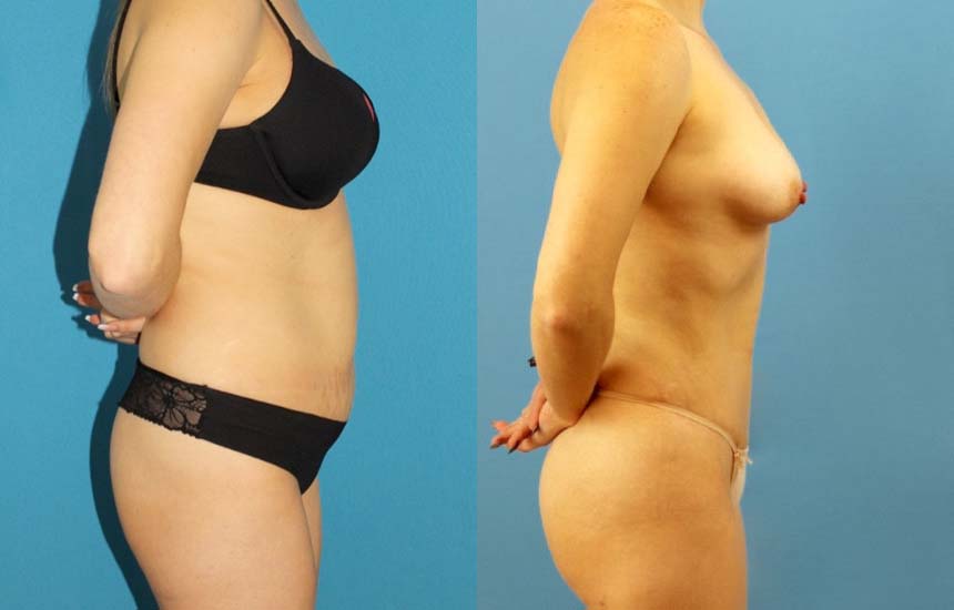 Tummy Tuck case #7343