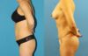 Tummy Tuck case #7343 slider thumbnail