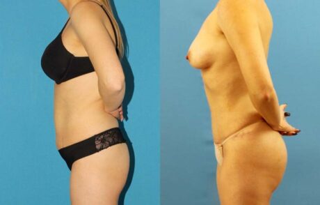 Tummy Tuck case #7343
