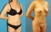 Tummy Tuck case #7343 slider thumbnail