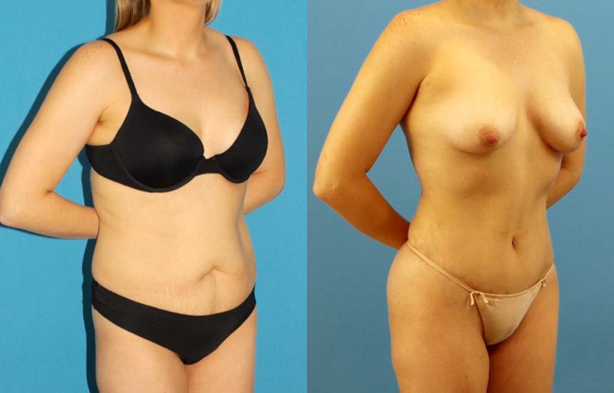 Tummy Tuck case #7343