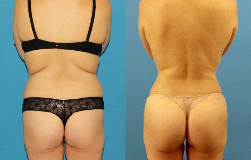 Tummy Tuck case #7343